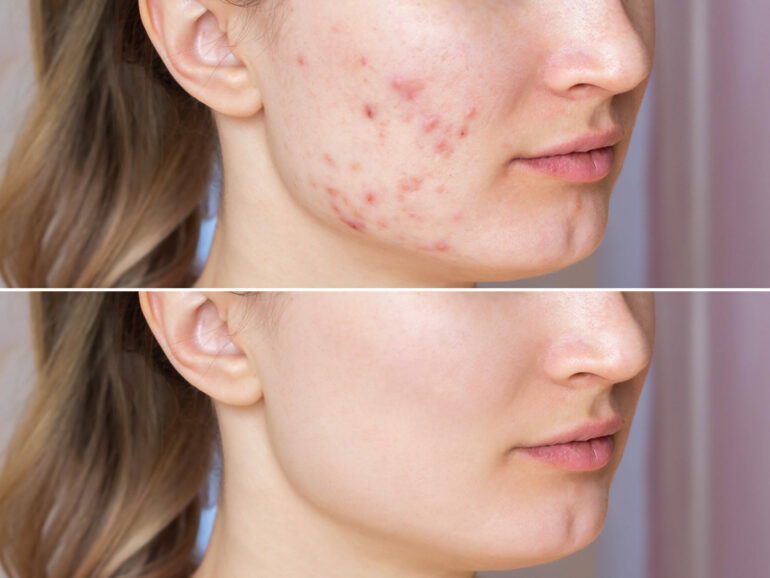 Cropped shot of a young woman's face before and after acne trea